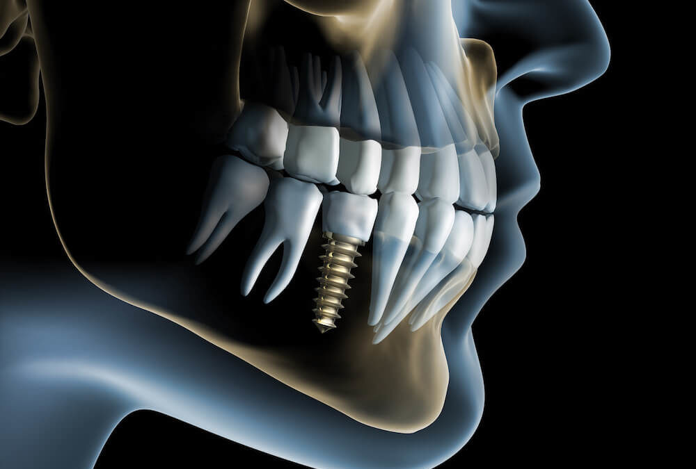 Dental Implant Trend