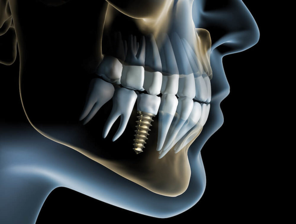 Dental Implants Des Moines Cosmetic Dentistry Center