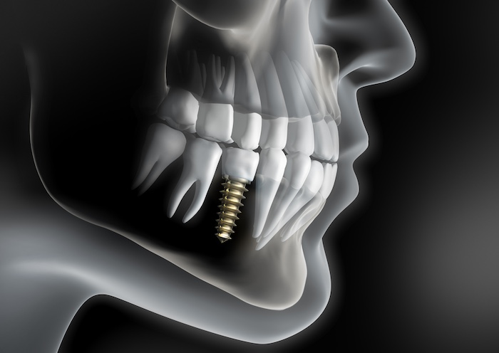 Dental Implant Trend