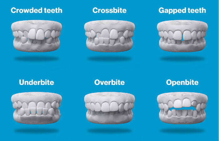 clear teeth aligners