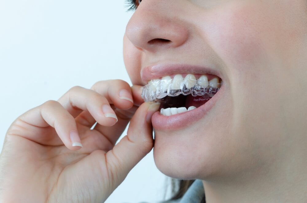 Which Teeth Aren’t Suitable for Invisalign?