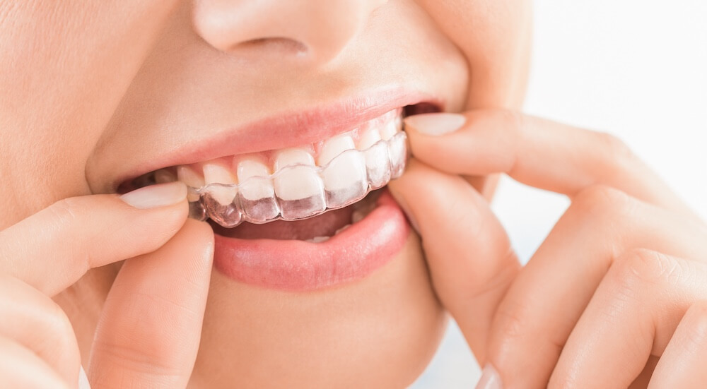 Which Teeth Are Hardest To Move With Invisalign?
