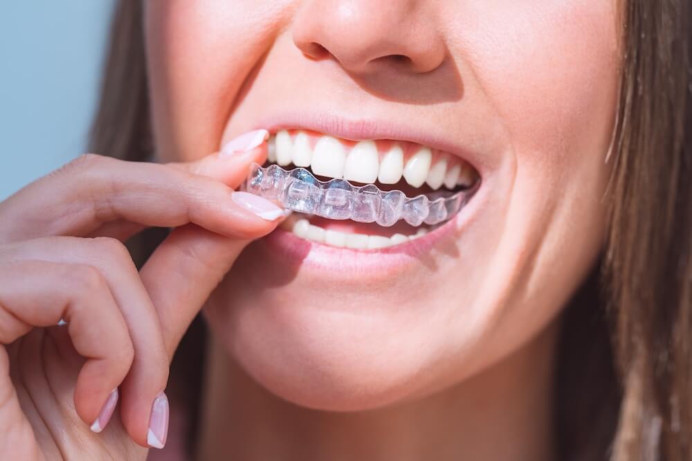 Do People Really Wear Invisalign 22 Hours a Day?