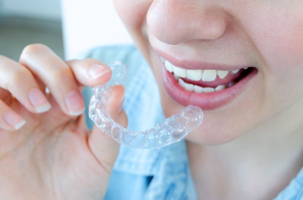 Invisalign-Attachments