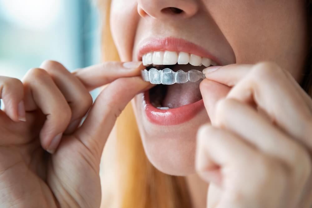 Avoiding Common Invisalign Mistakes for Best Results