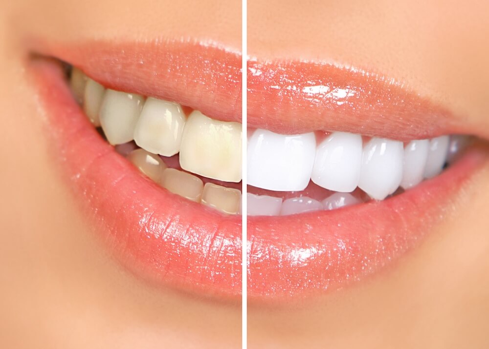 Veneers