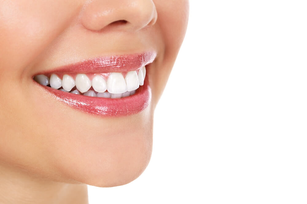 How Many Veneers Do You Need?
