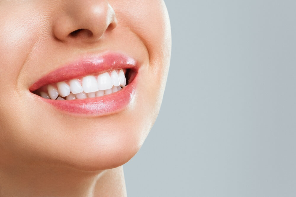 Woman with Porcelain Veneers