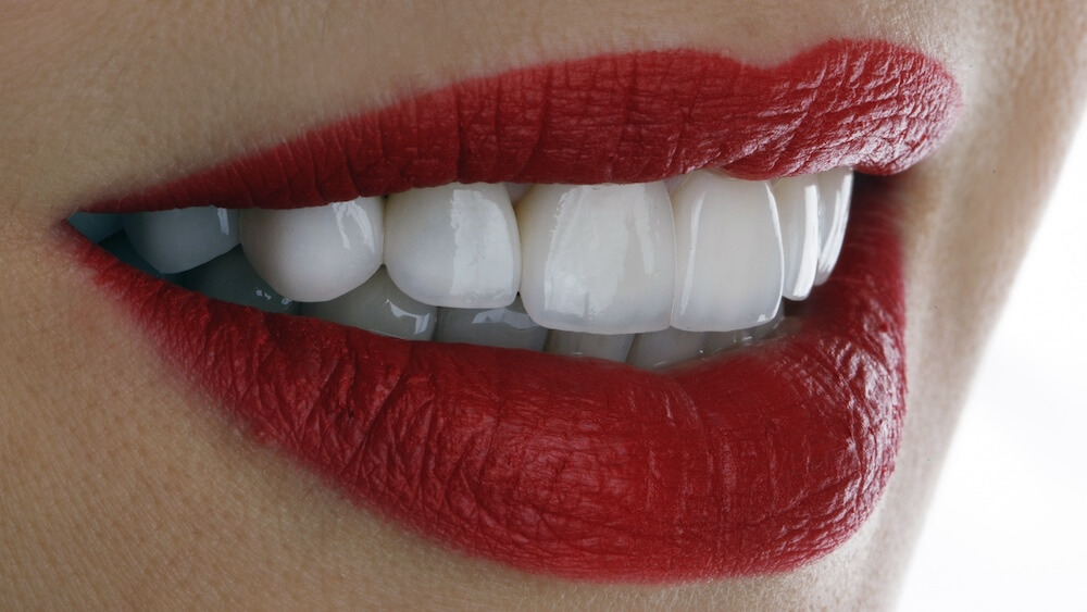 Are Dental Veneers Worth It?