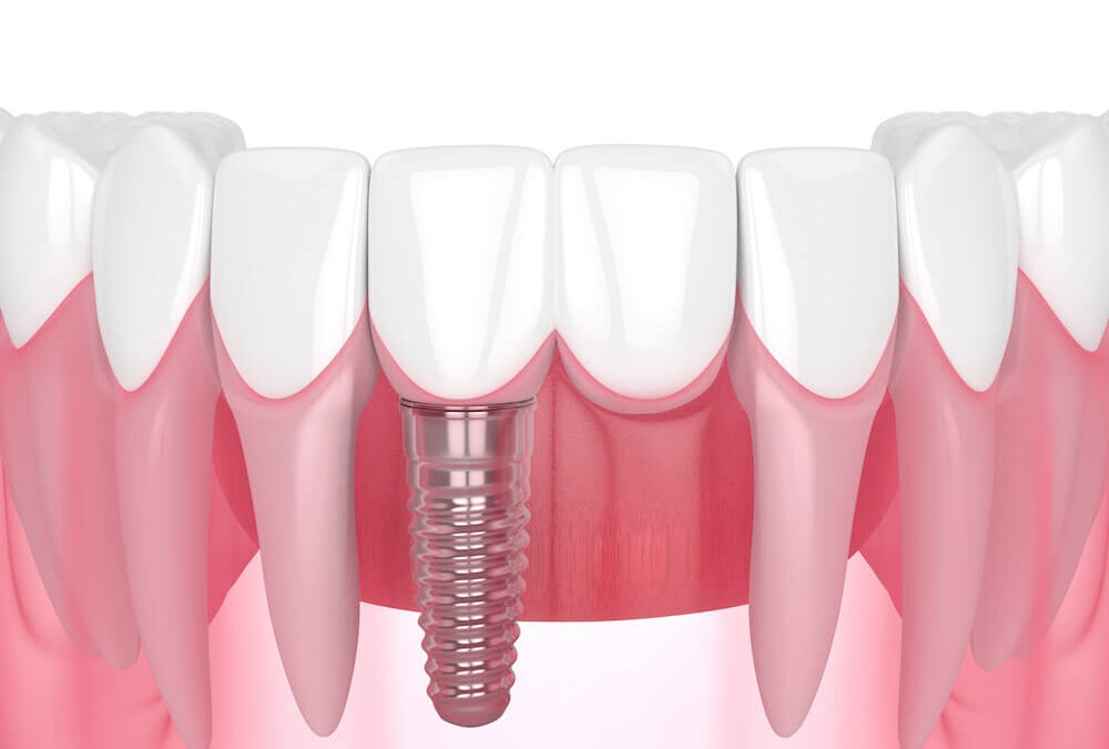 What to Expect During Dental Implant Surgery: Replacing Missing Teeth with Confidence