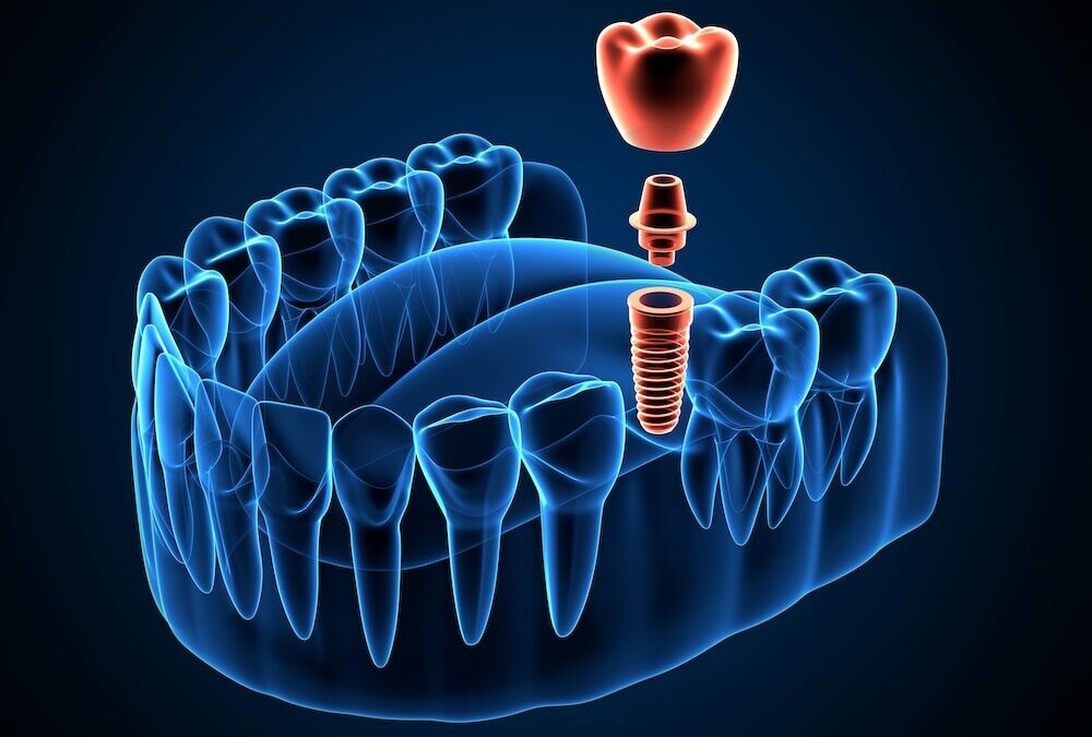 Dental Implant Surgery vs Implant Crown: What’s the Difference?