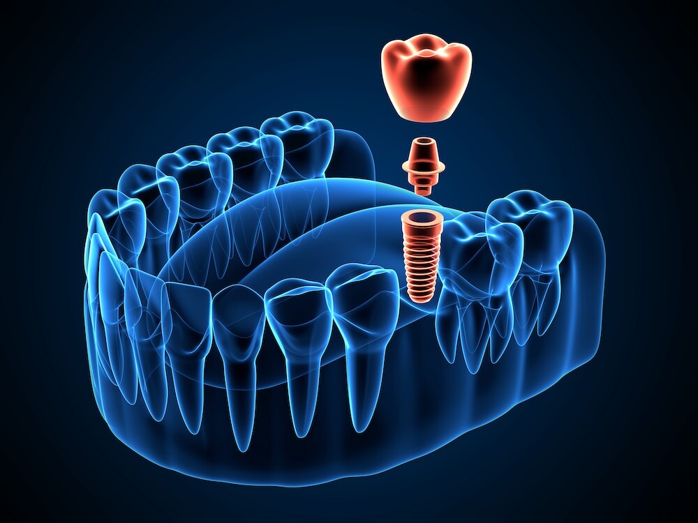 Dental Implants Des Moines Iowa Dental Implants Des Moines Iowa