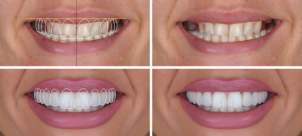 Porcelain Veneers Des Moines Cosmetic Dentistry Center