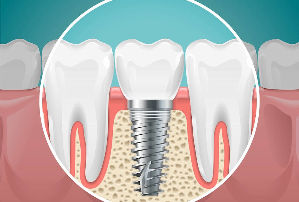 Are Dental Implants or Dentures Better Long-Term?