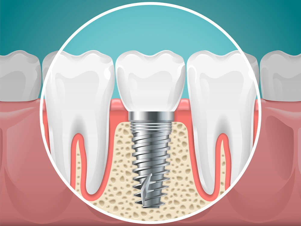 Dental Implant Illustration