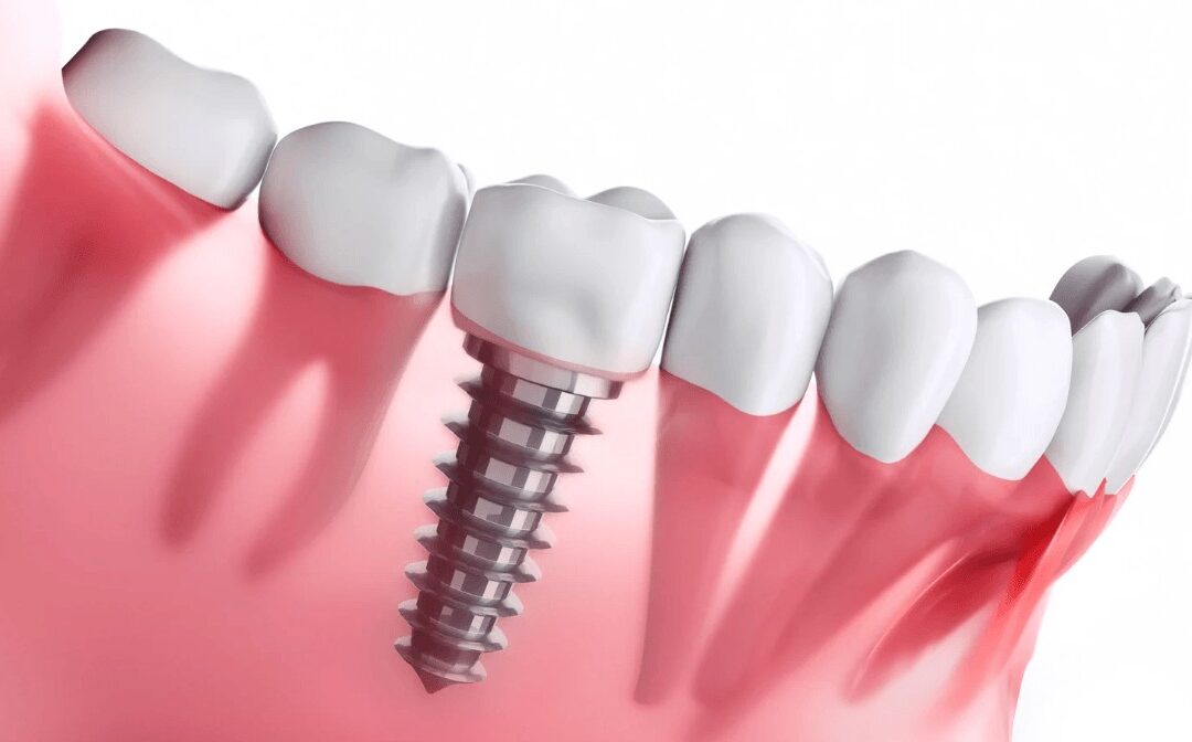 Single Tooth Dental Implant vs Multiple Implants What’s the Difference?