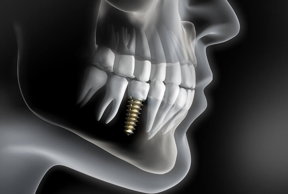 Recovery After Dental Implant Surgery Week-By-Week Guide