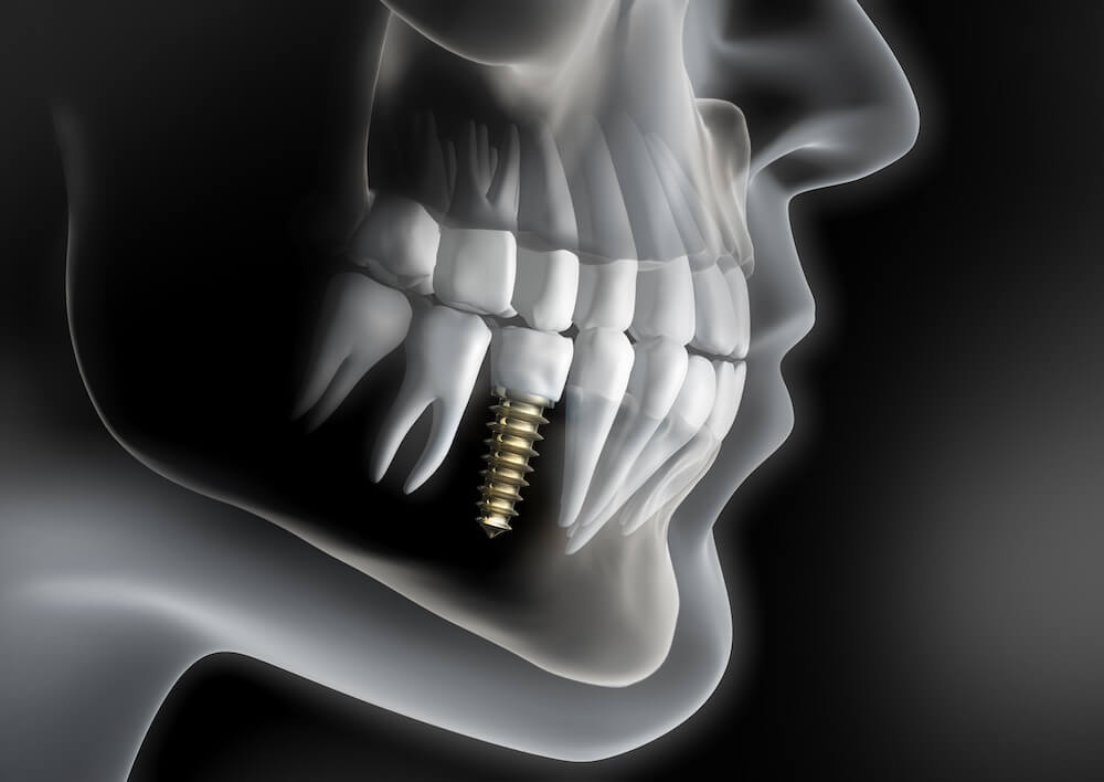 Dental Implants in Jaw